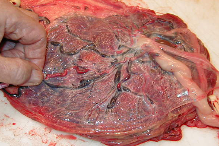 A kóros placenta megjósolhatja az autizmus kialakulását újszülötteknél