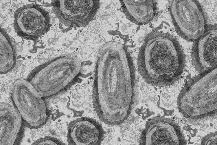 Megfertőződött a majomhimlővel egy gyerek Németországban